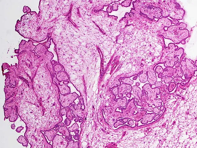 Dynamic Mesothelioma Of The Omentum Artwork for Mobile