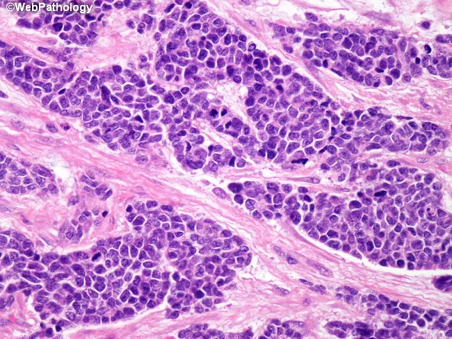 Desmoplastic Small Round Cell Tumor