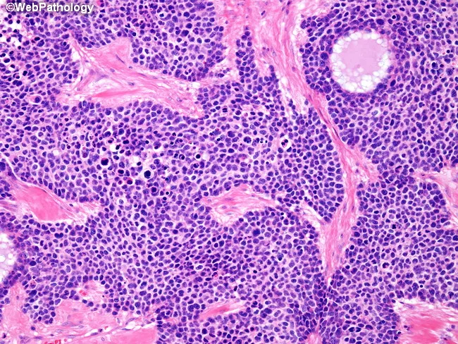 Desmoplastic Small Round Cell Tumor
