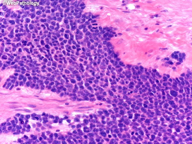 Desmoplastic Small Round Cell Tumor