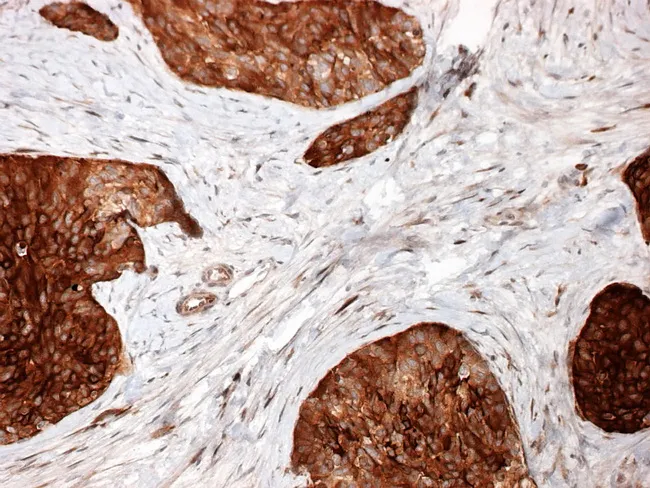 Desmoplastic Small Round Cell Tumor : NSE