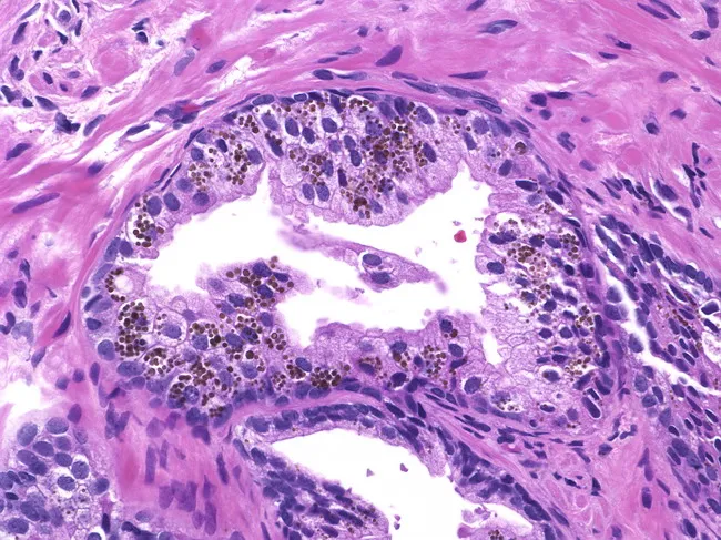 Pigment in Prostatic Epithelium