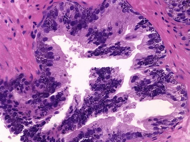 Pigment in Prostatic Epithelium