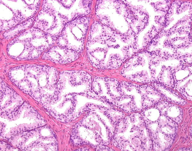 Clear Cell Cribriform Hyperplasia