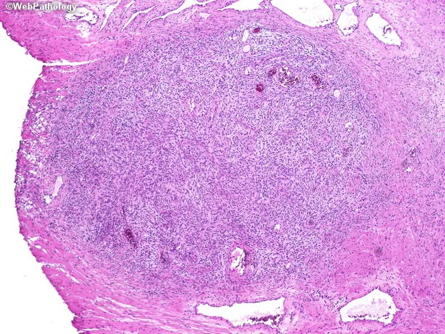 prostate stromal hyperplasia icd 10