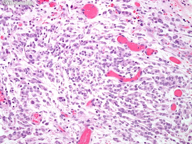 Chordoid Meningioma