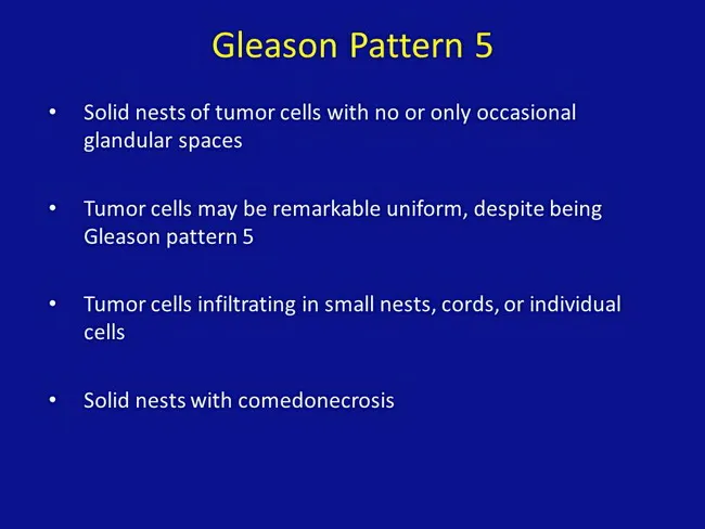 Gleason Pattern 5