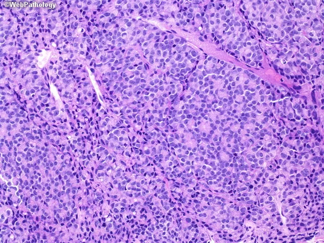Prostate Adenocarcinoma Gleason