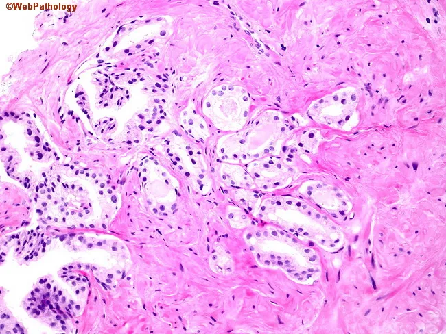 Partial Atrophy