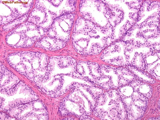 Clear Cell Cribriform Hyperplasia