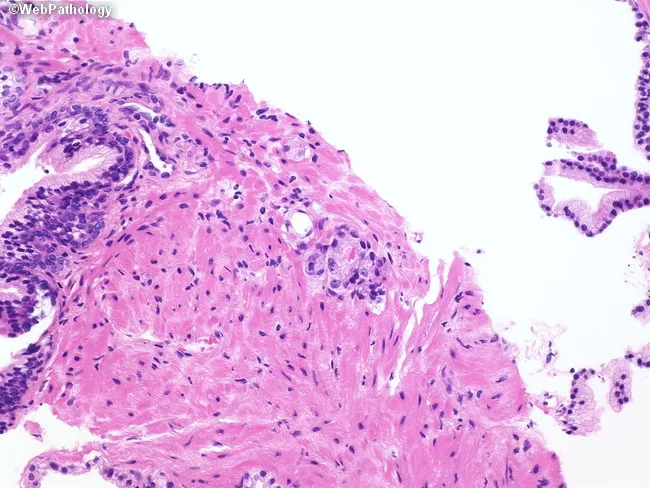 Atypical Glands in Prostate Biopsy