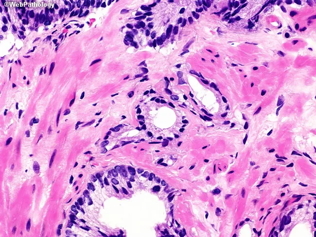 Atypical Glands in Prostate Biopsy