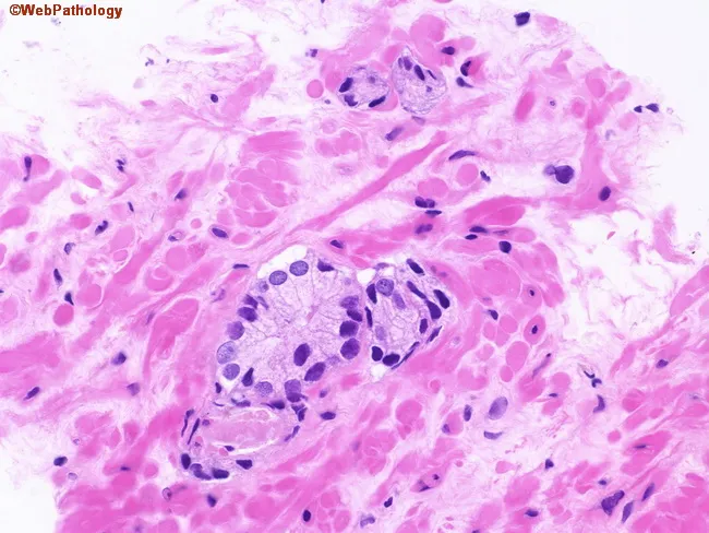 Atypical Glands in Prostate Biopsy