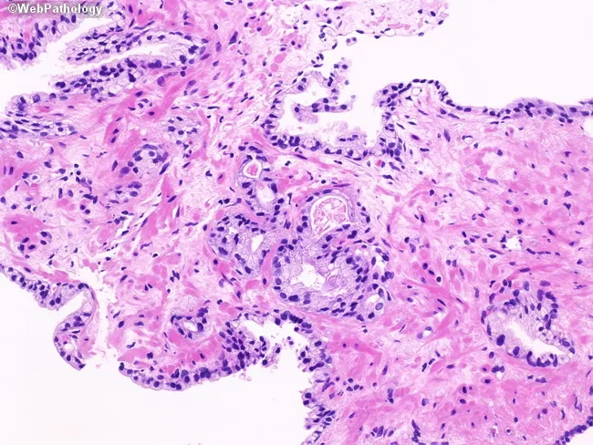 Atypical Glands in Prostate Biopsy