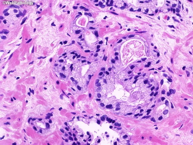 Atypical Glands in Prostate Biopsy