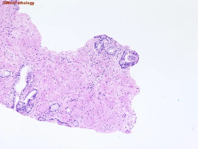 Atypical Glands in Prostate Biopsy