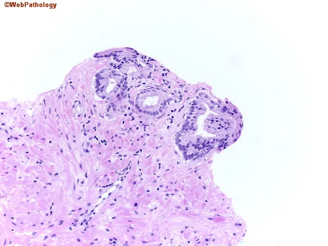 Atypical Glands in Prostate Biopsy
