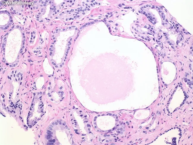 Prostate Cancer : Atrophic Variant