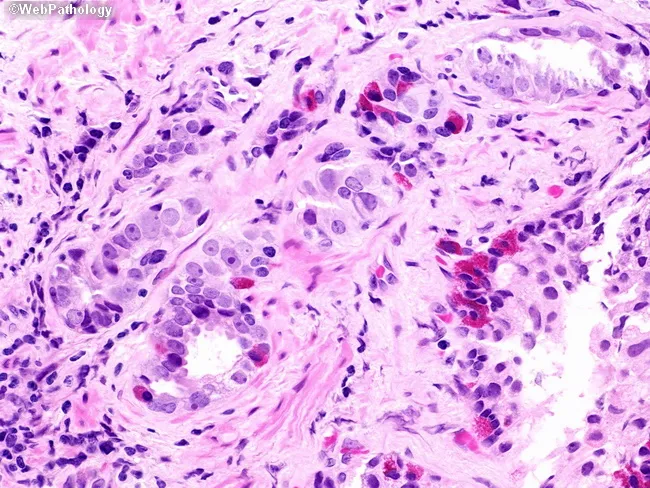 Prostate Cancer : Neuroendocrine Cells