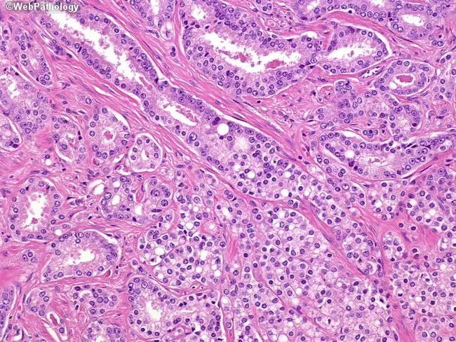 Prostate Cancer : Signet Ring-Cell Type