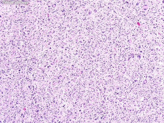 Stromal Sarcoma of Prostate