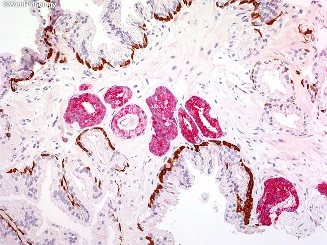 PIN-4 Cocktail in Prostate Cancer