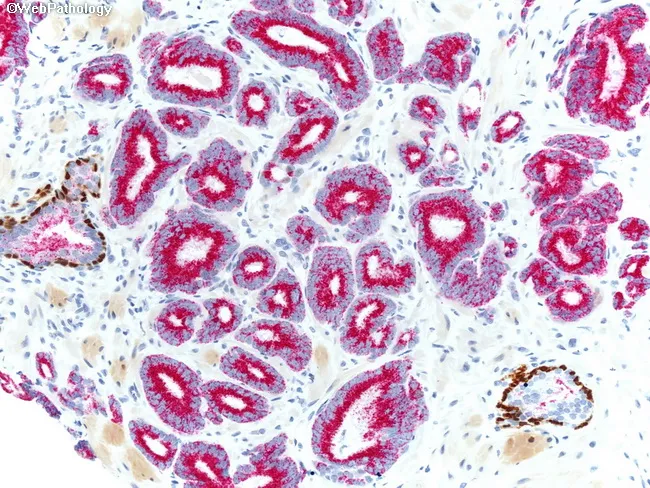 PIN-4 Cocktail in Prostate Cancer