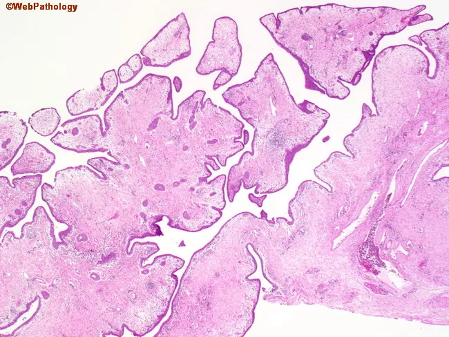 Polypoid Cystitis