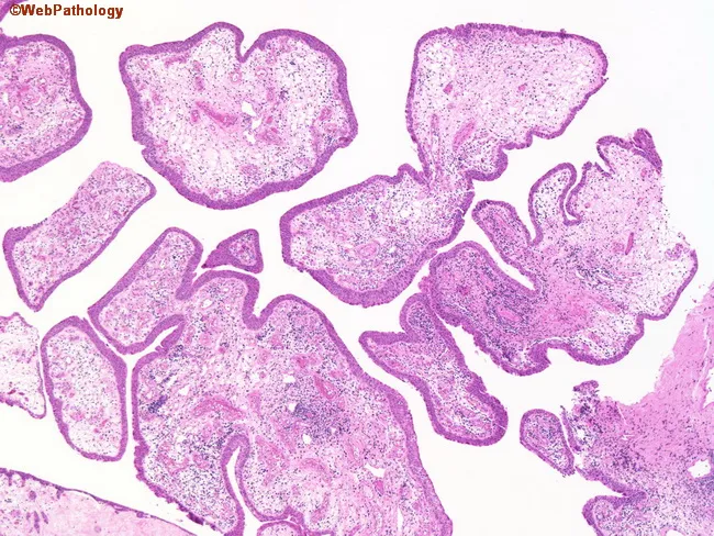 Polypoid Cystitis