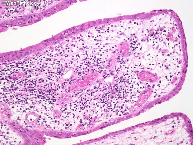 Polypoid Cystitis