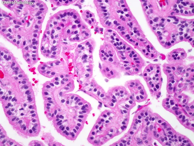 choroid plexus carcinoma pathology outlines