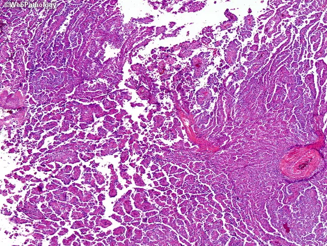 choroid plexus carcinoma pathology outlines