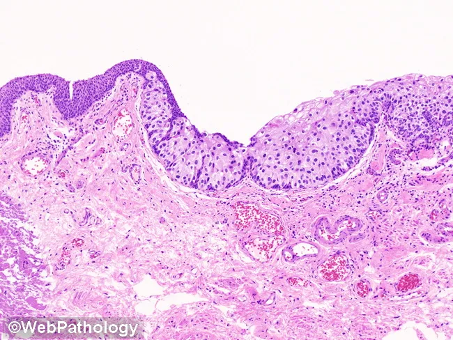 Urothelial Carcinoma-In-Situ : Pagetoid Spread