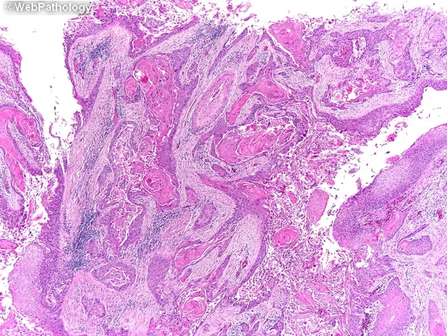 Squamous Cell Carcinoma of Bladder