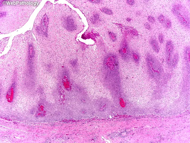 Viscera Infest – Verrucous Carcinoma（帯付） Cervical verrucous cancer misdiagnosed with verrucous