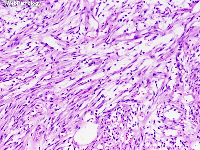 Post-operative Spindle Cell Nodule