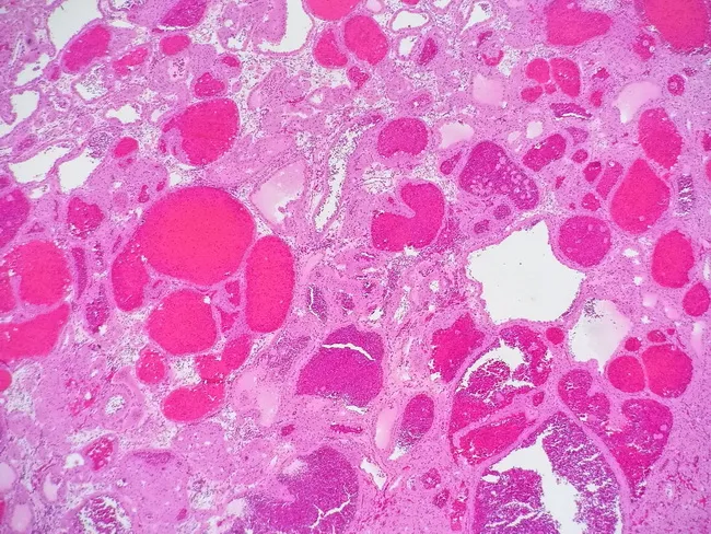 Telangiectatic Oncocytoma