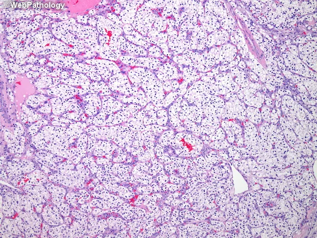 Clear Cell Renal Cell Carcinoma