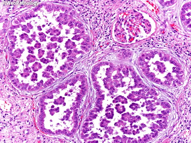 Renal Papillary Cell Carcinoma Differentiation Of Papillary Renal Cell