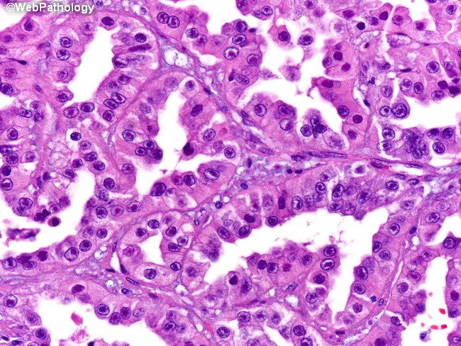 Papillary Renal Cell Carcinoma, Type 2
