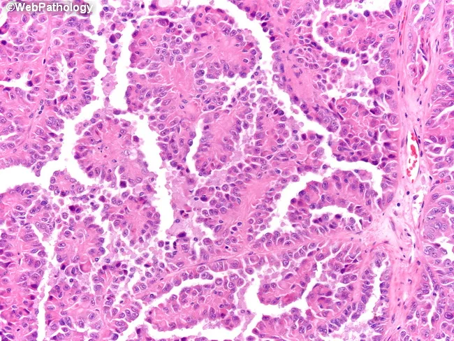 Papillary Renal Cell Carcinoma, Type 2