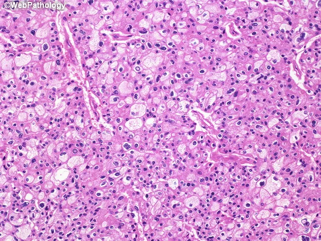 Chromophobe Renal Cell Carcinoma