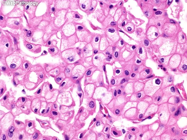 Chromophobe Renal Cell Carcinoma