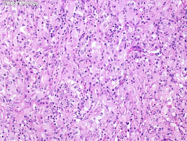 Sarcomatoid Renal Cell Carcinoma