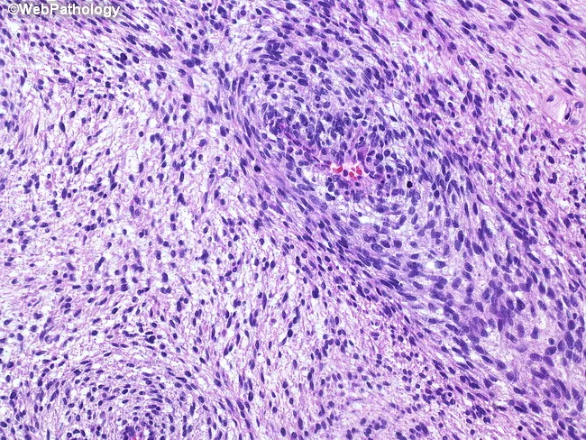 Sarcomatoid Renal Cell Carcinoma