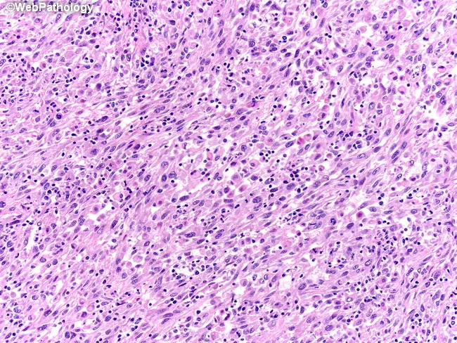Sarcomatoid Renal Cell Carcinoma