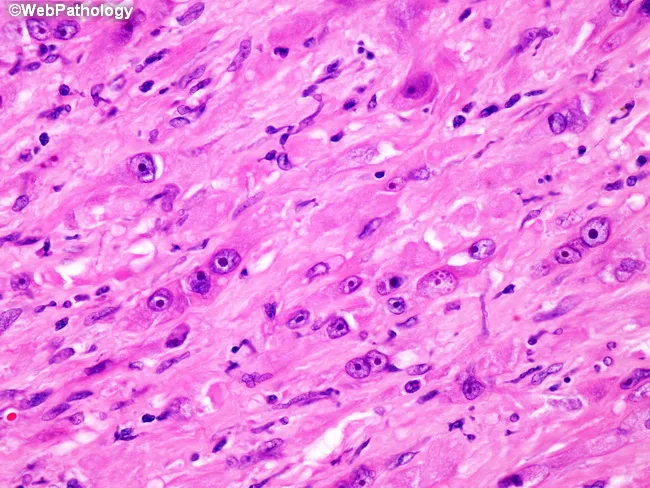 Sarcomatoid Renal Cell Carcinoma