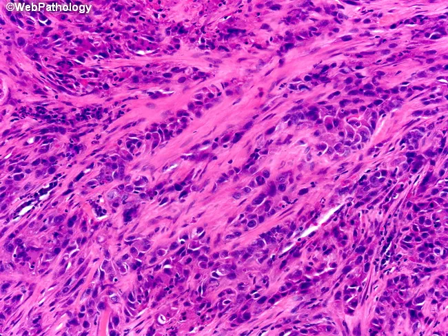 Sarcomatoid Renal Cell Carcinoma