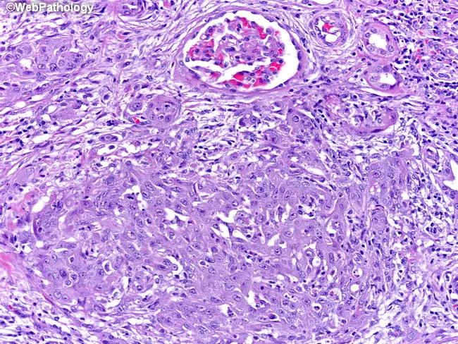 Renal Medullary Carcinoma Pathology Outlines