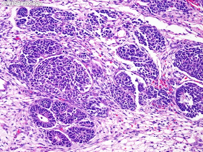 Wilms Tumor : Triphasic